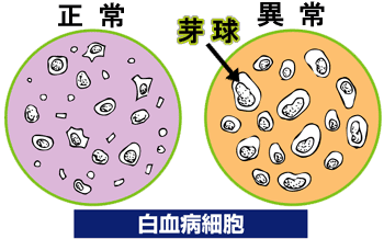 白血病細胞
