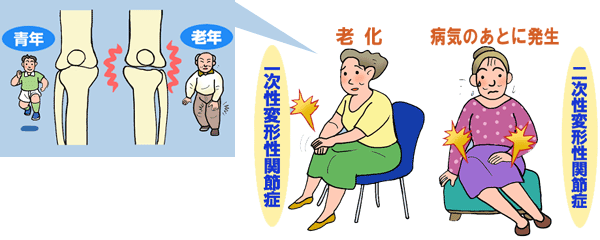 一時性変形性関節症と二次性変形性関節症