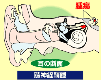 聴神経鞘腫