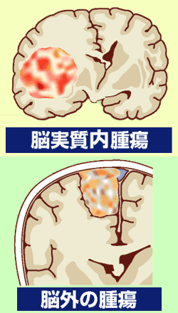 脳実質内腫瘍・脳外の腫瘍