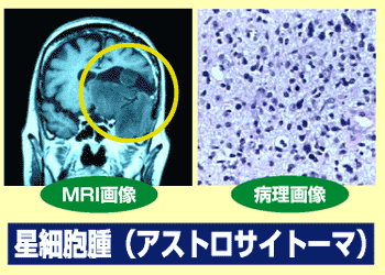 星細胞腫(アストロサイトーマ)
