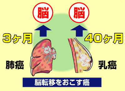 脳転移をおこす癌