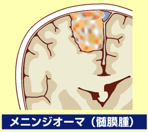 メニンジオーマ