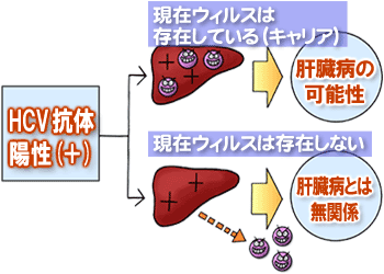 HCV抗体陽性の場合