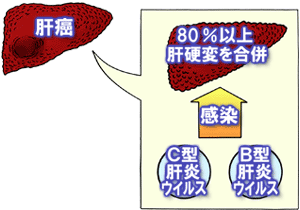 80%以上が肝硬変を合併