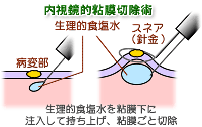 内視鏡的粘膜切除術