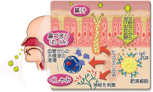 アレルギー性鼻炎
