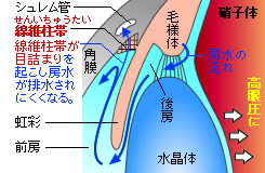 開放隅角緑内障