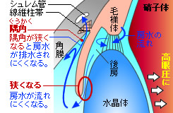 閉塞隅角緑内障
