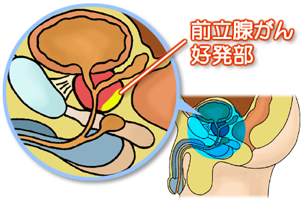 前立腺がん好発部